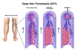 BLOOD CLOTS & MASSAGE DURING PREGNANCY & POSTPARTUM - LESLIE STAGER RN, LMT